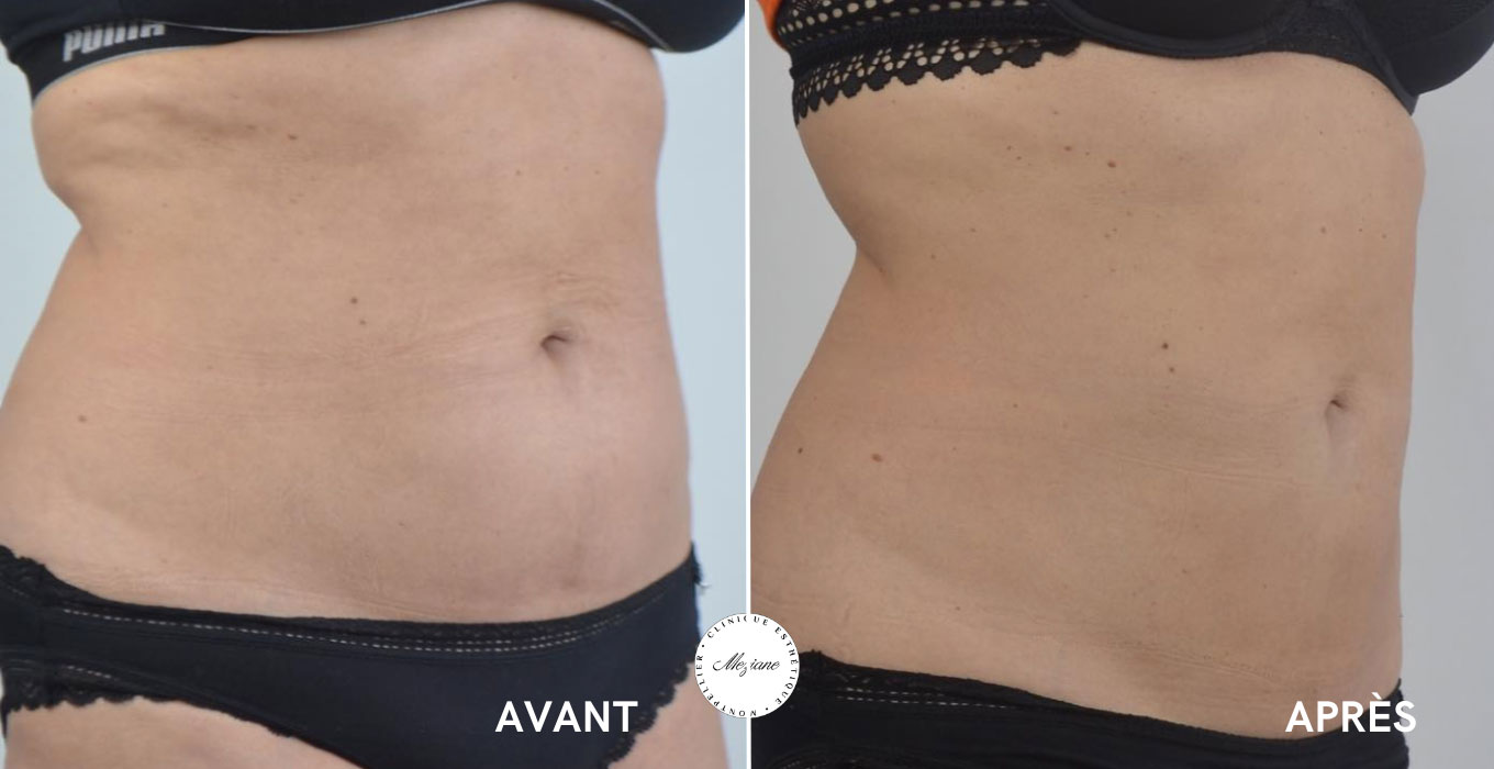 lifting visage sans chirurgie montpellier