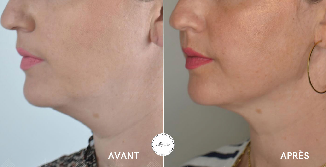 hydrafacial montpellier