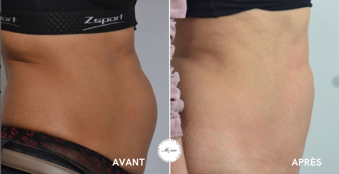 microneedling montpellier