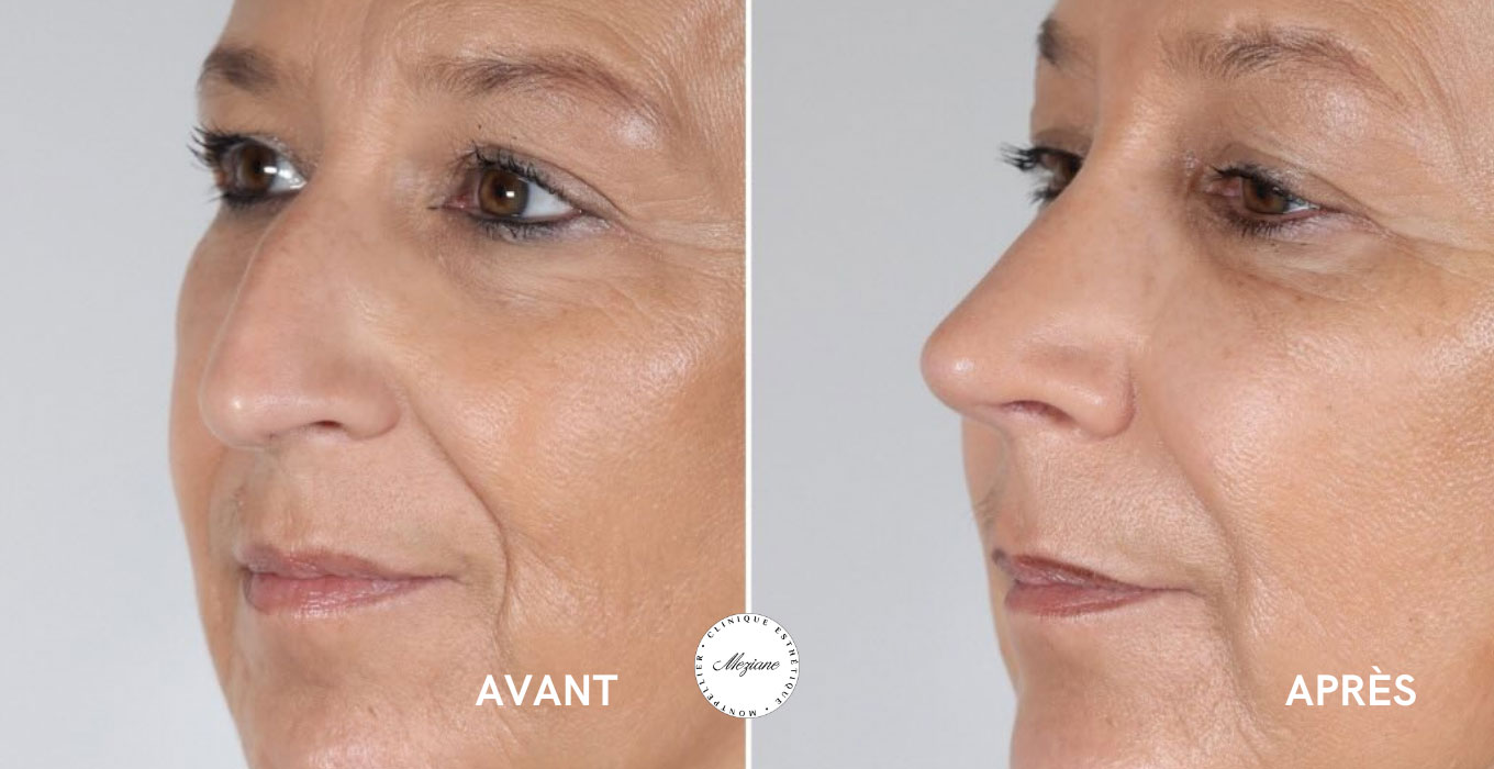 lifting visage montpellier