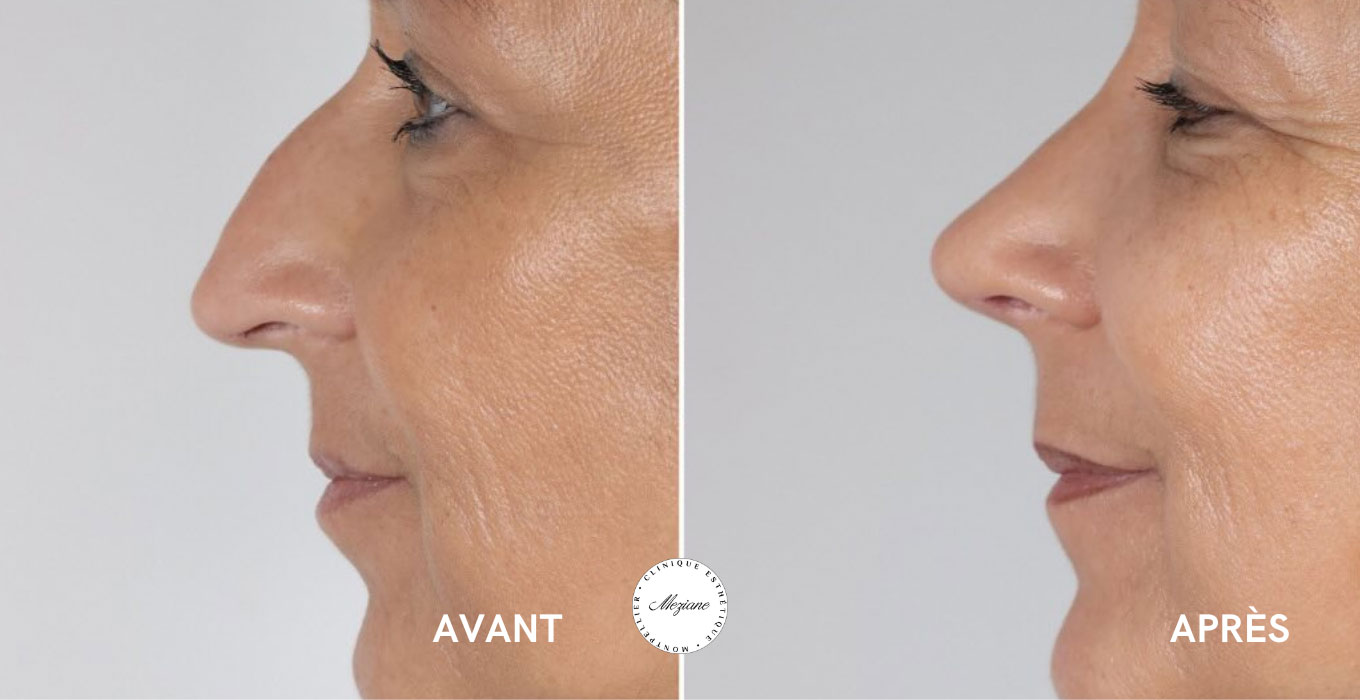 rhinoplastie montpellier