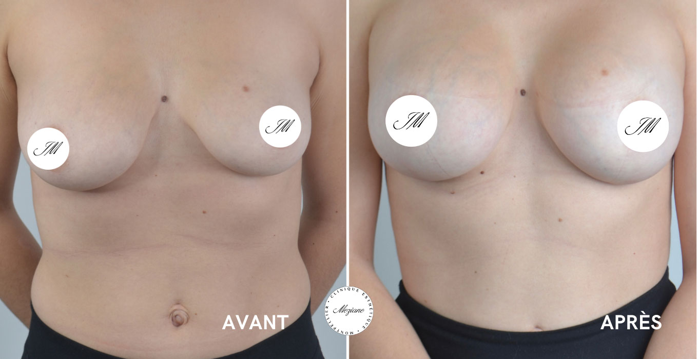 epilation laser montpellier