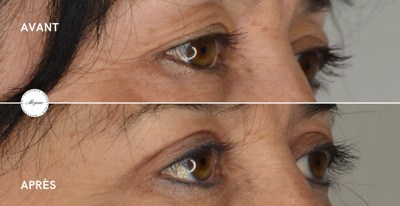 detatouage laser montpellier