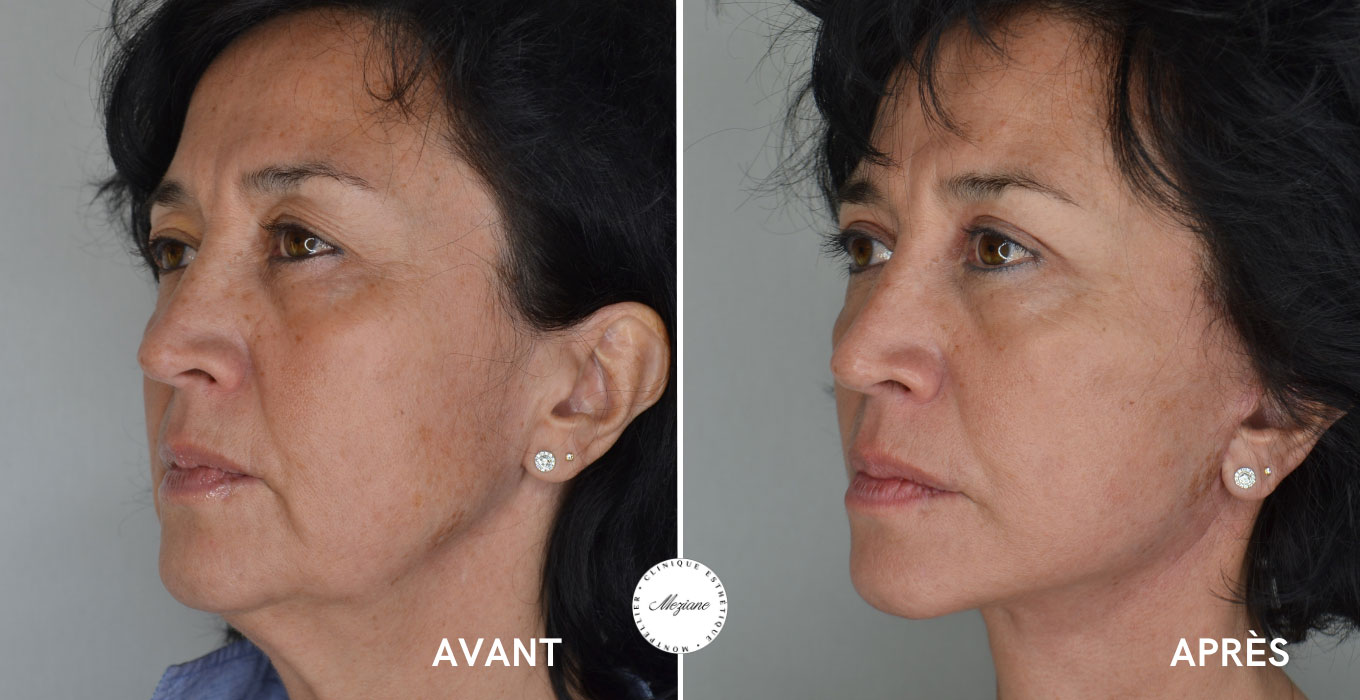 detatouage laser montpellier