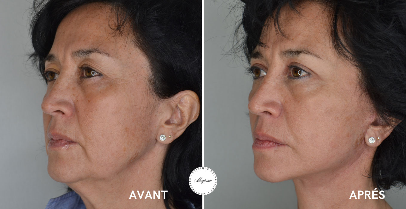 blepharoplastie montpellier