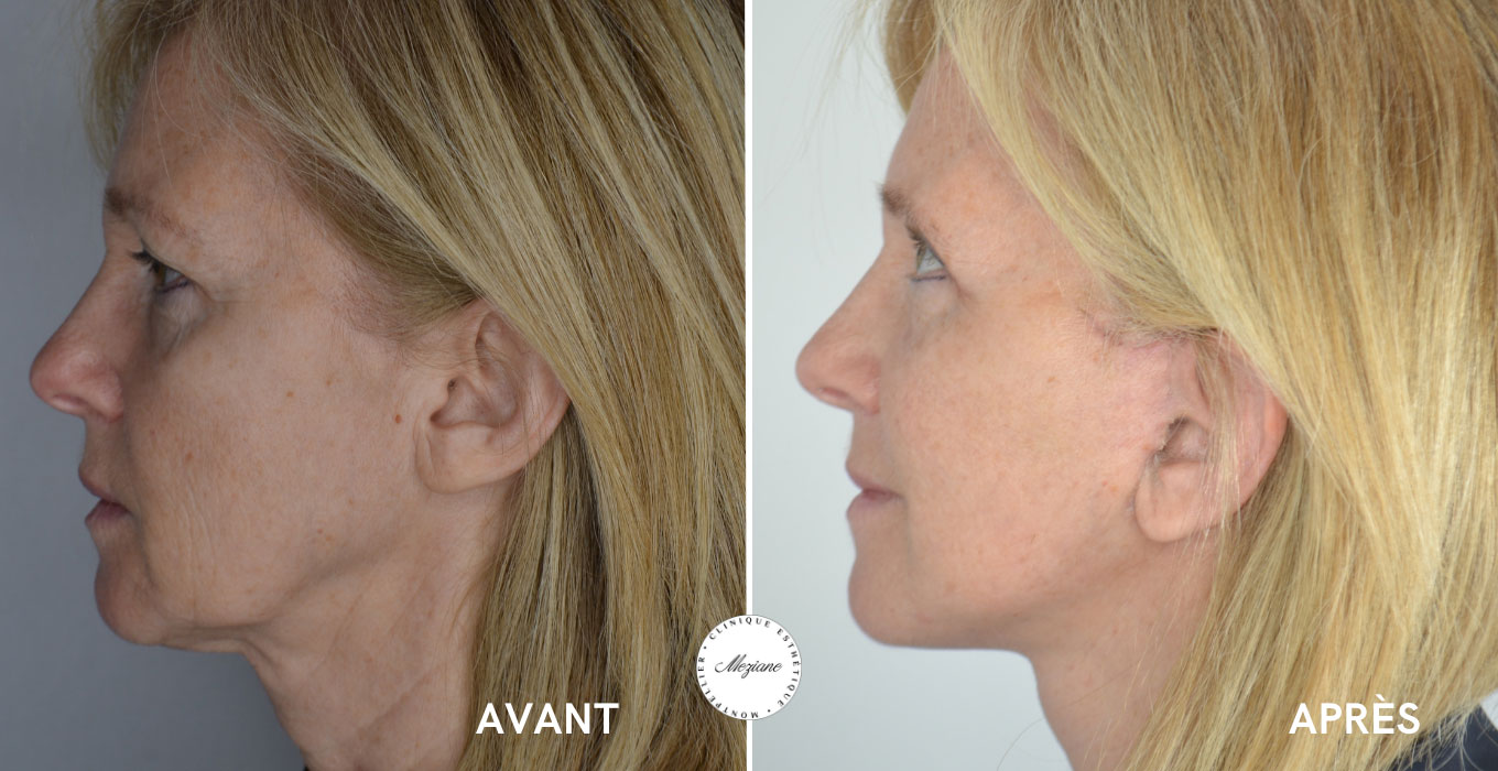 epilation definitive montpellier