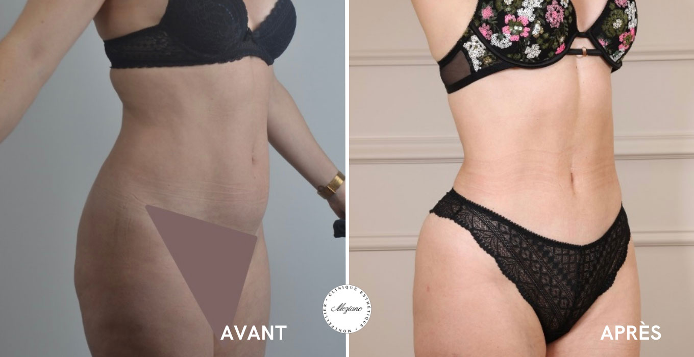 rhinoplastie montpellier