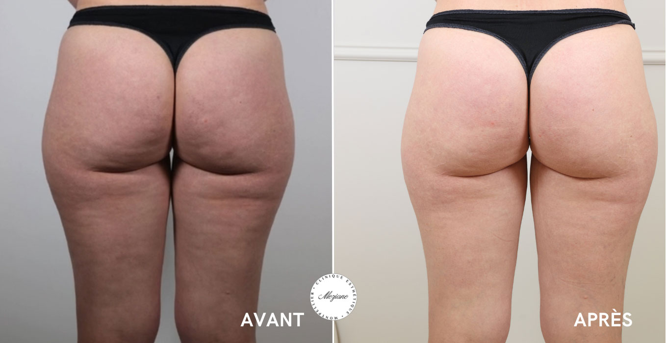 epilation laser a montpellier