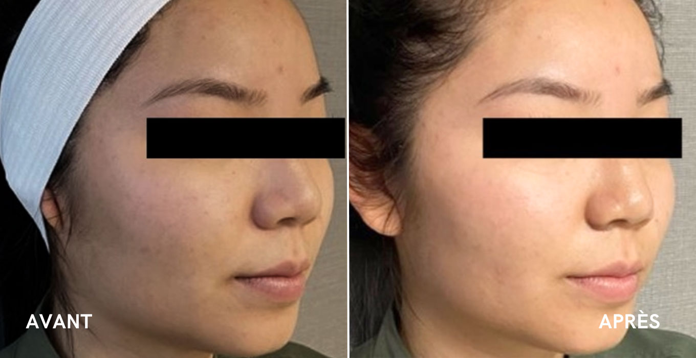 lifting visage sans chirurgie a montpellier