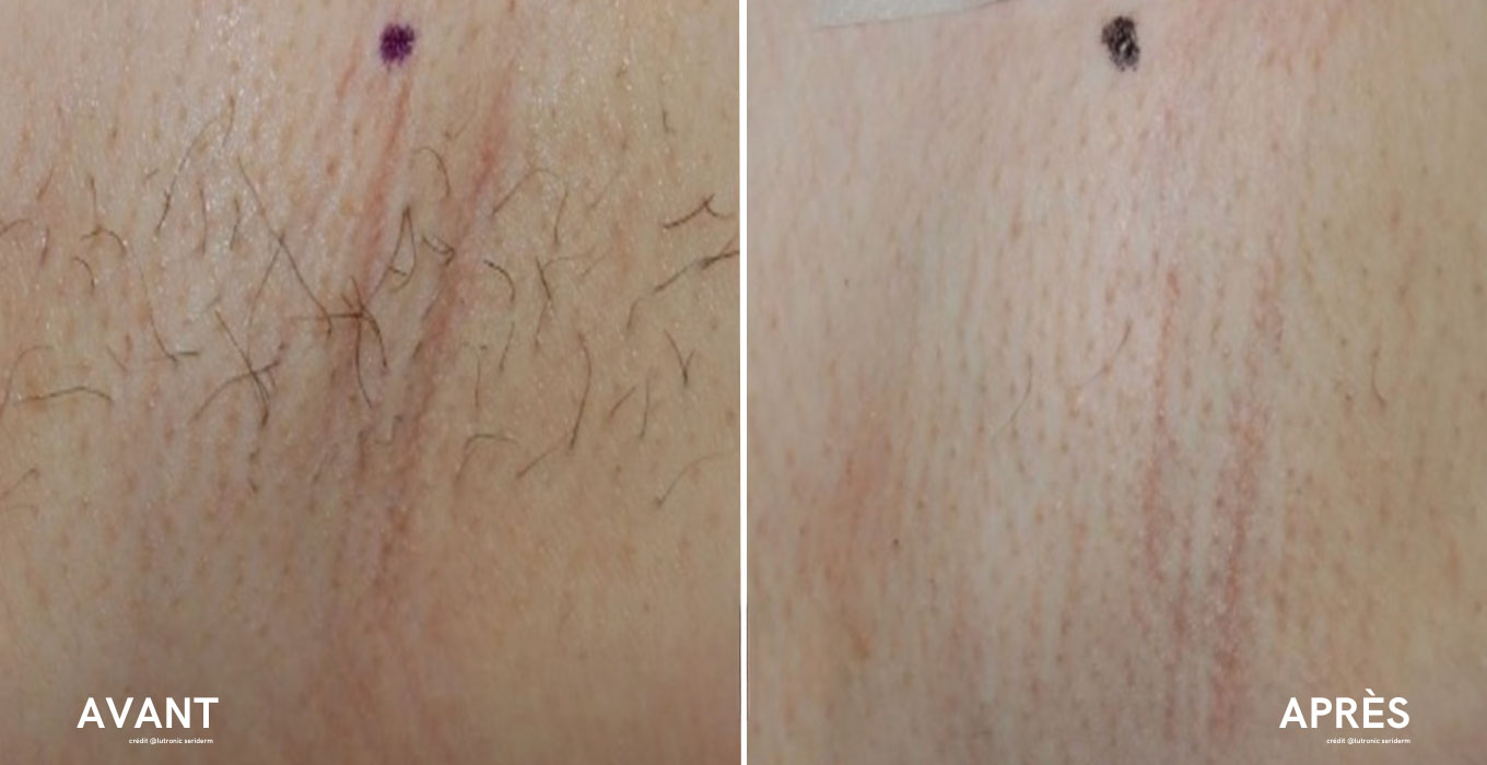 traitement dermapen a montpellier