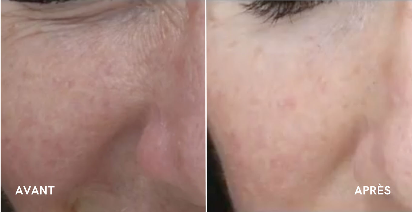 epilation definitive montpellier