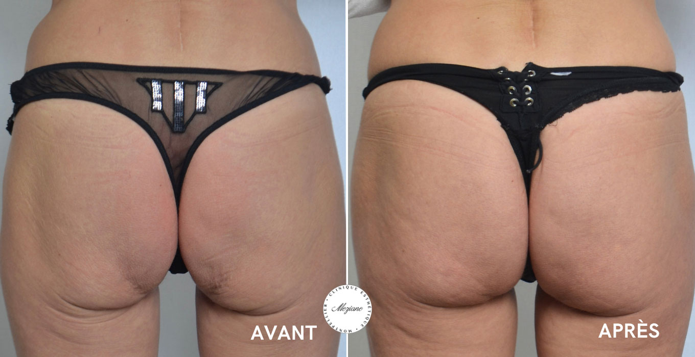 detatouage laser montpellier