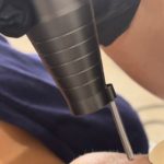 traitement esthetique visage montpellier