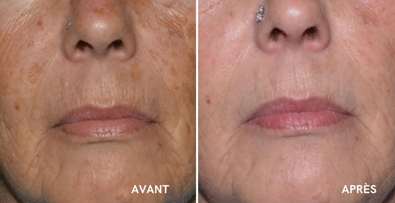 soin esthetique visage montpellier