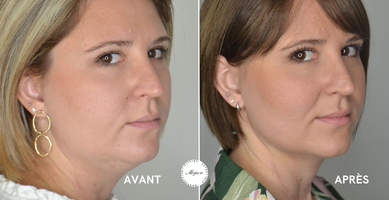 lifting mammaire montpellier