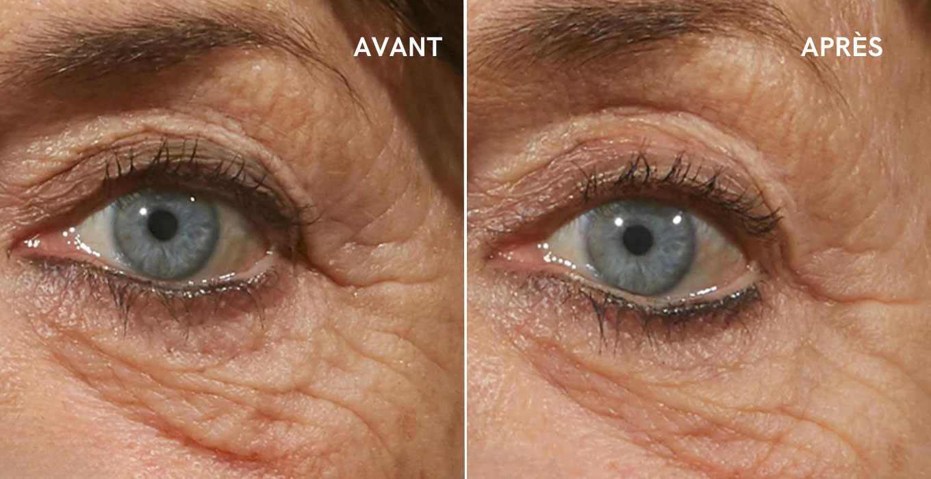 microneedling a montpellier