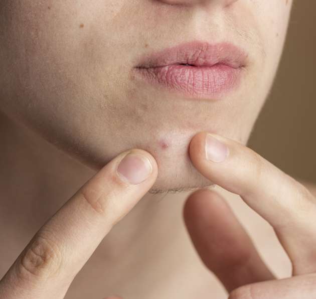 lifting visage sans chirurgie montpellier