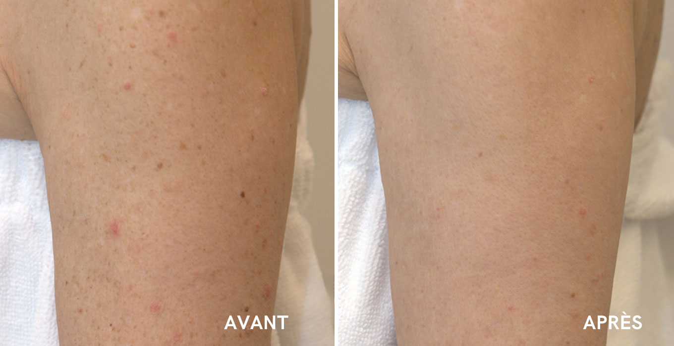 injection acide hyaluronique a montpellier
