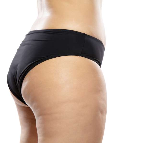 epilation definitive montpellier