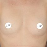 rhinoplastie a montpellier