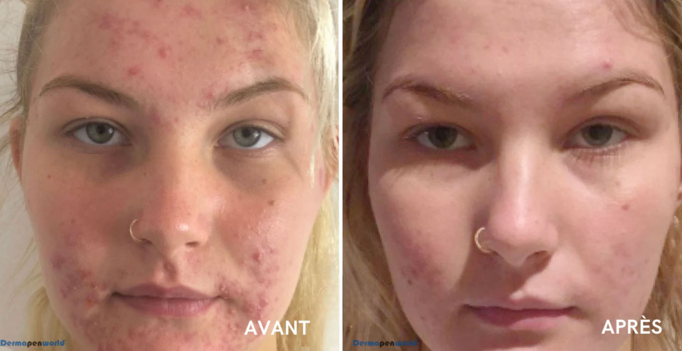 blepharoplastie montpellier