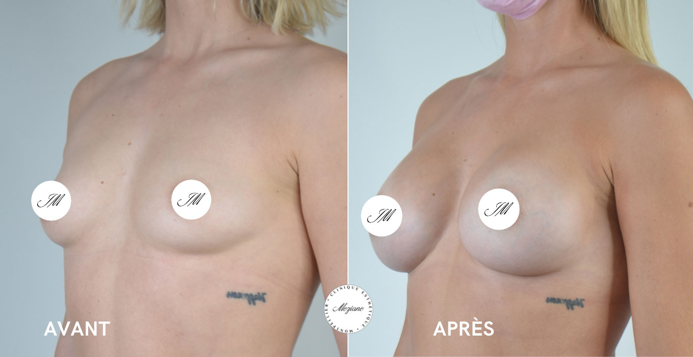injection botox a montpellier