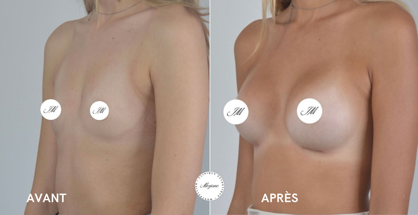 injection acide hyaluronique a montpellier