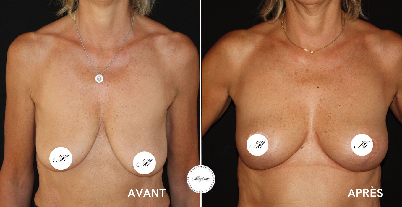 injection acide hyaluronique montpellier