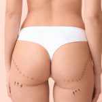 coolsculpting montpellier