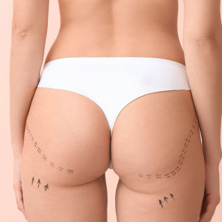 coolsculpting montpellier