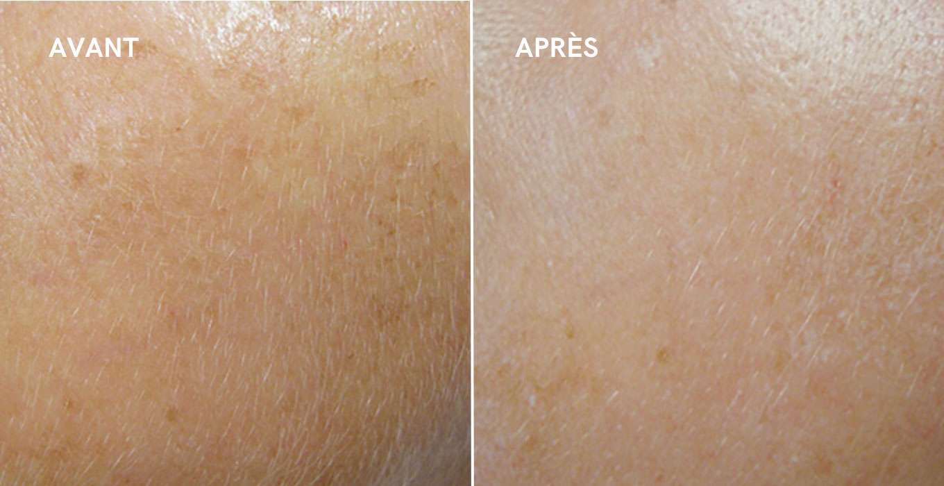 epilation laser a montpellier