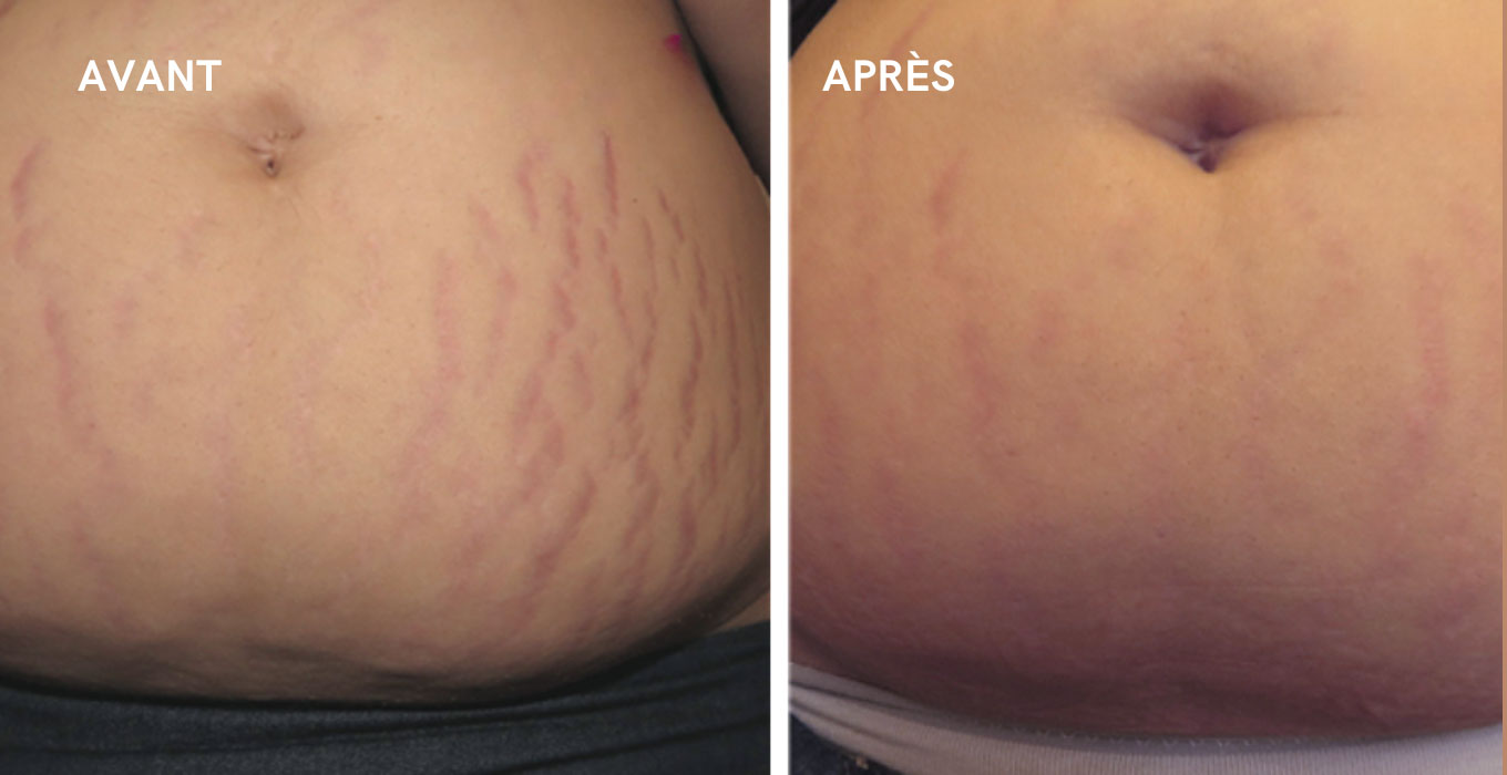 traitement dermapen a montpellier