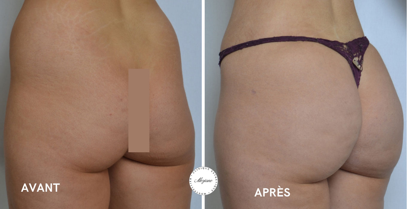 rhinoplastie montpellier